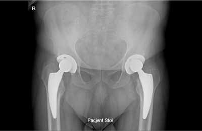 W mojej praktyce stosuję nowoczesny, małoinwazyjny dostęp przedni – technikę MIS DAA (Minimally Invasive Surgery – Direct Anterior Approach)